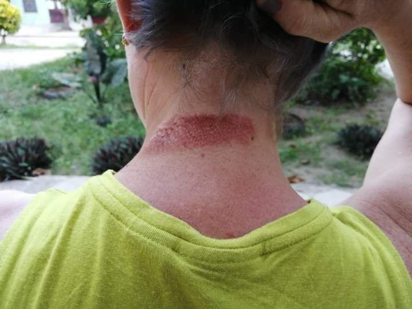 Maylen Díaz Delgado muestra la huella del golpe recibido por una agente de la policía durante las protestas del 11 de julio de 2021